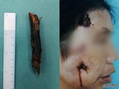 沐鸣总代理56岁的女子脸上反复化脓，在过去的两年里，医生取了8厘米长的树枝