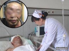 半邊臉被咬脫縫100多針 黑龍江護林工被熊襲擊
