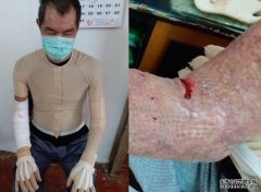 沐鸣平台开户马鞍山遭纵火男子回家休养 穿压力衣起水泡流血