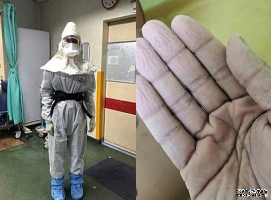 沐鸣招商主管医护上载双手发白起皱相 网民高呼好心痛