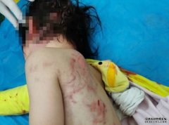 沐鸣主管广西4岁女童被狗撕咬 遍体鳞伤惨不忍睹