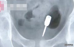 9岁男童贪玩飞镖塞肛门 沐鸣平台挂机软件下载险刺穿肠道