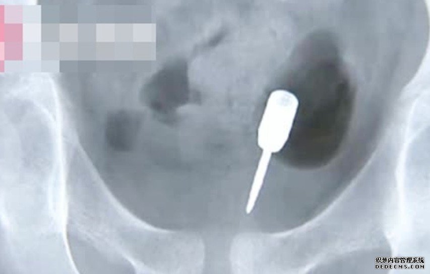 9岁男童贪玩飞镖塞肛门 沐鸣平台挂机软件下载险刺穿肠道