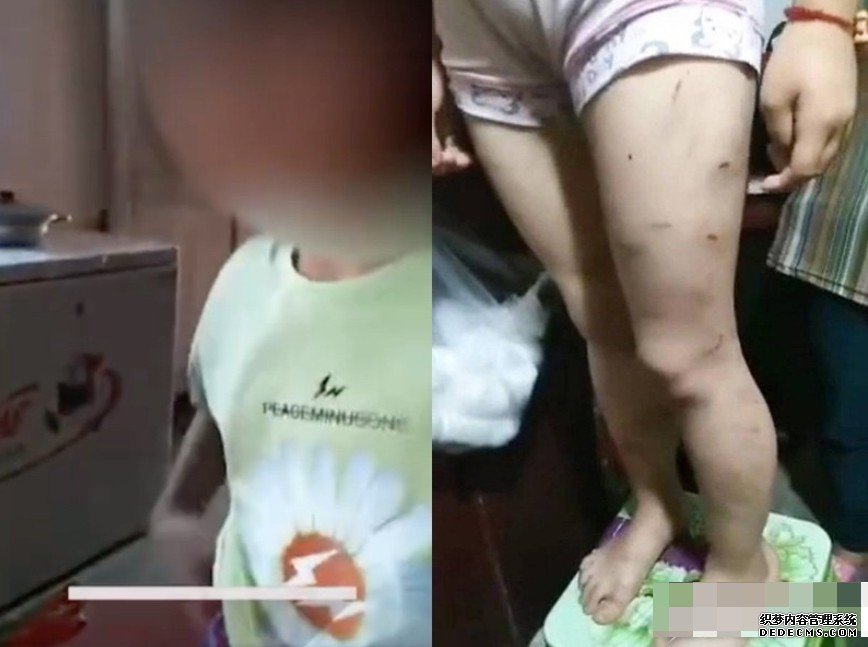 沐鸣登录线路测速网传贵州女童长期被家暴致满身伤痕 警：仅家长教育方式不当