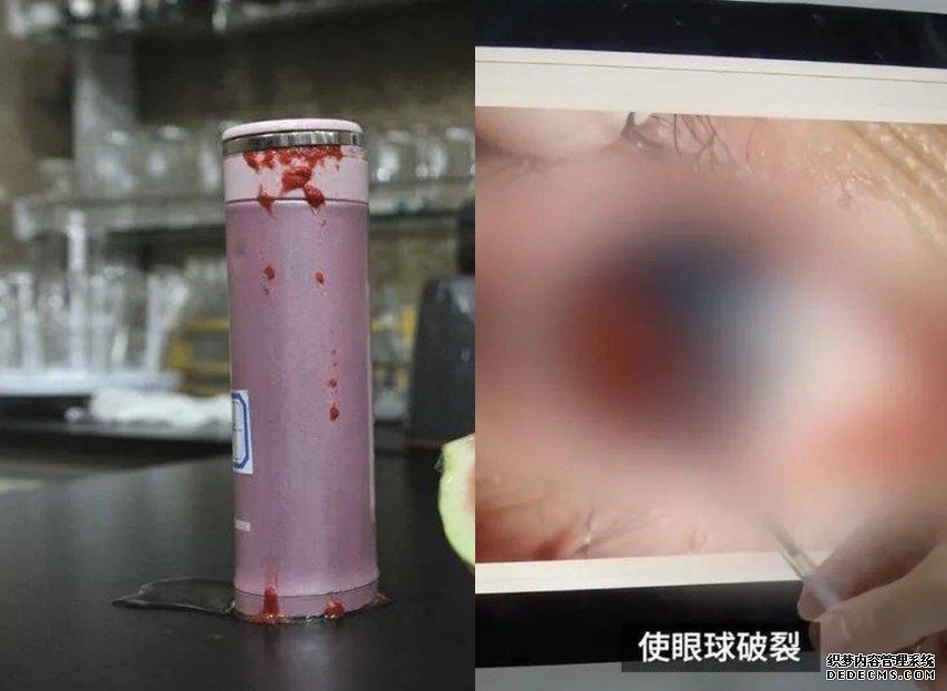 保温杯红枣水放十沐鸣总代理多天 女子开瓶爆炸弹伤右眼