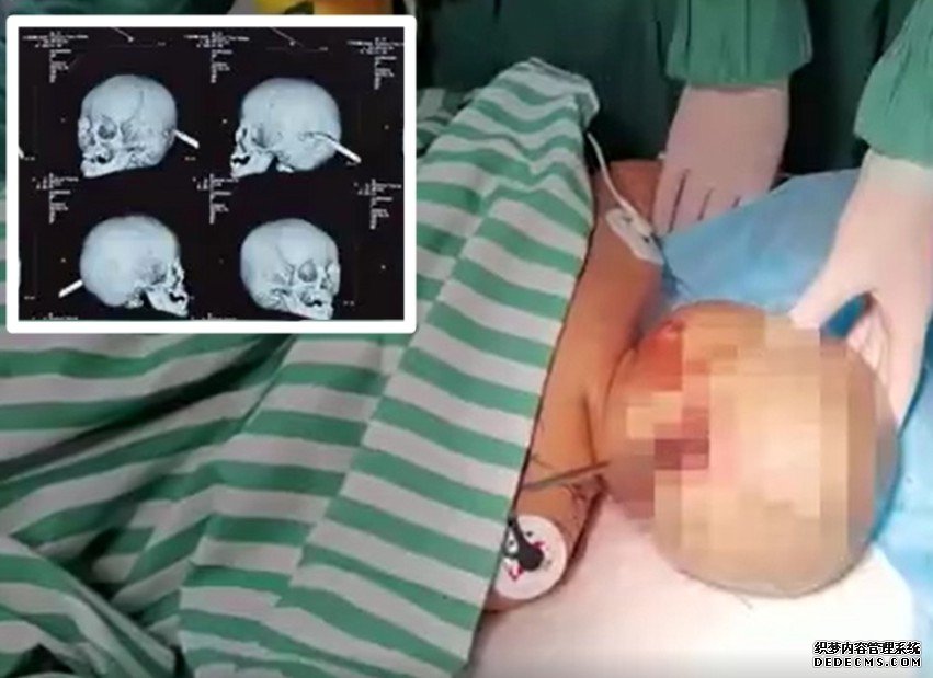 沐鸣总代理江苏20月大男婴「碌落床」 15厘米修脚刀直插头部