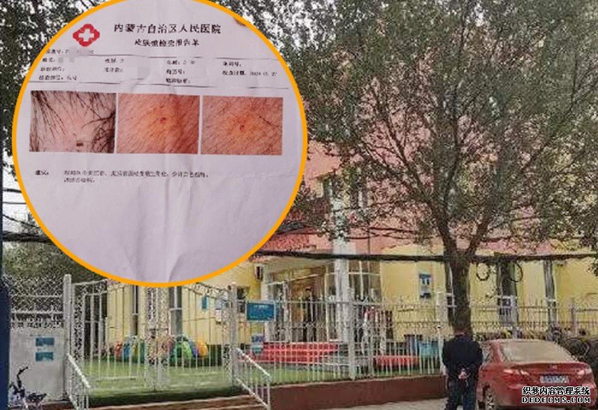 内蒙一间幼儿园多沐鸣招商主管名孩童身上现针眼 警方刑拘三名老师