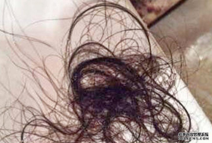 沐鸣代理招商中三女生食头髮揭患异食癖 腹痛送院开刀取出大团毛髮