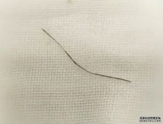 京汉「自行沐鸣总代理针灸」治腰痛 10厘米长针断体内送院