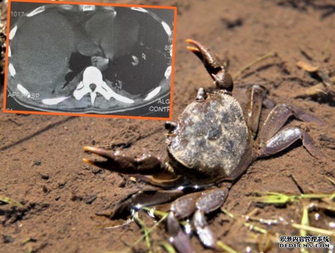 贵州男沐鸣代理招商子误信传闻生食蟹 全身感染寄生虫多器官衰竭