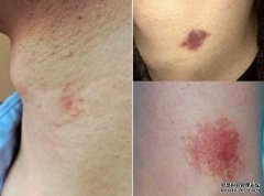 颈上长紫癜被女友认定是吻痕闹分手 男子沐鸣总代理喊冤到医院证清白